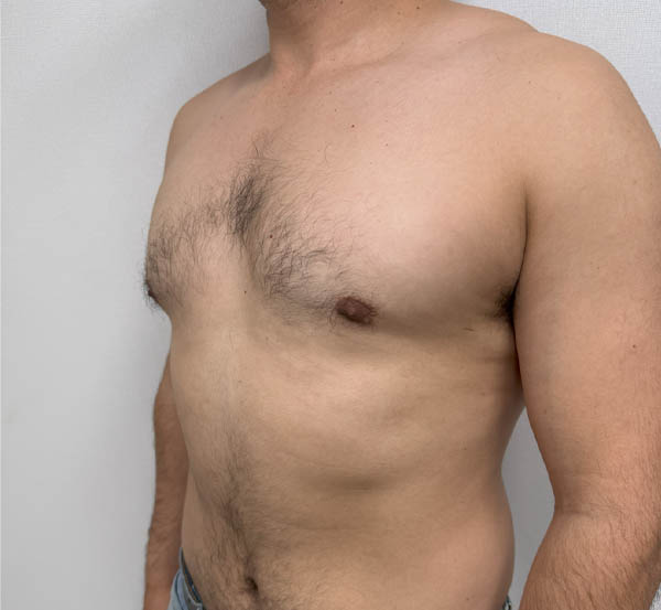 Gynecomastia