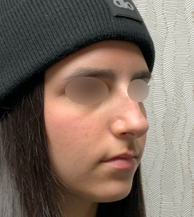 Rhinoplasty