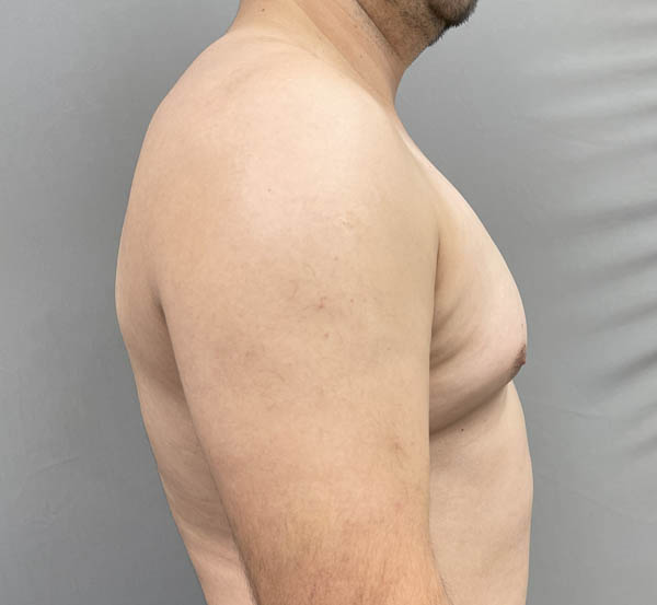 Gynecomastia