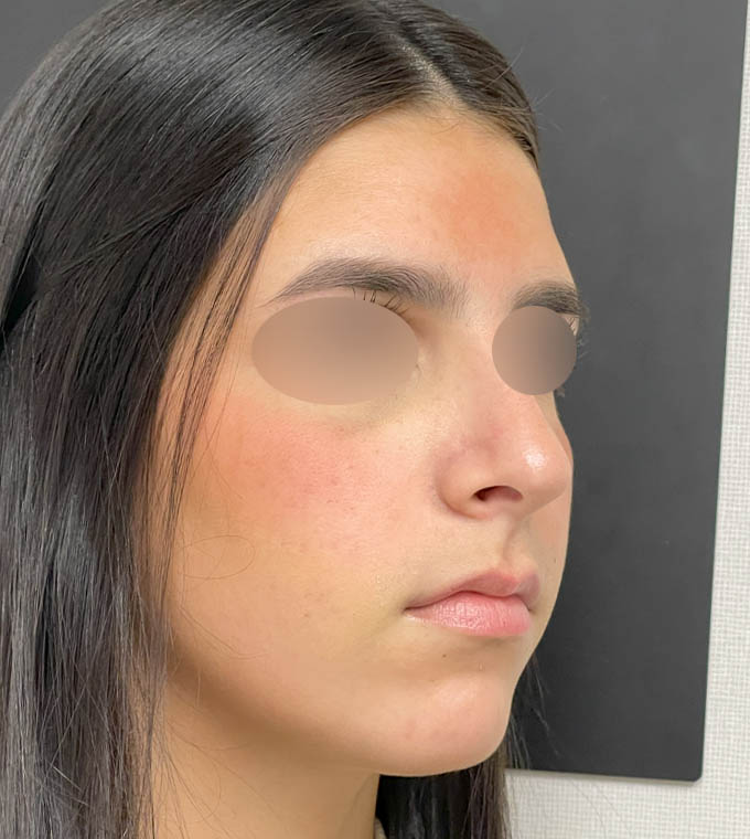 Rhinoplasty