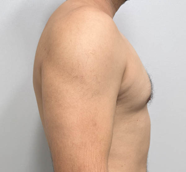 Gynecomastia