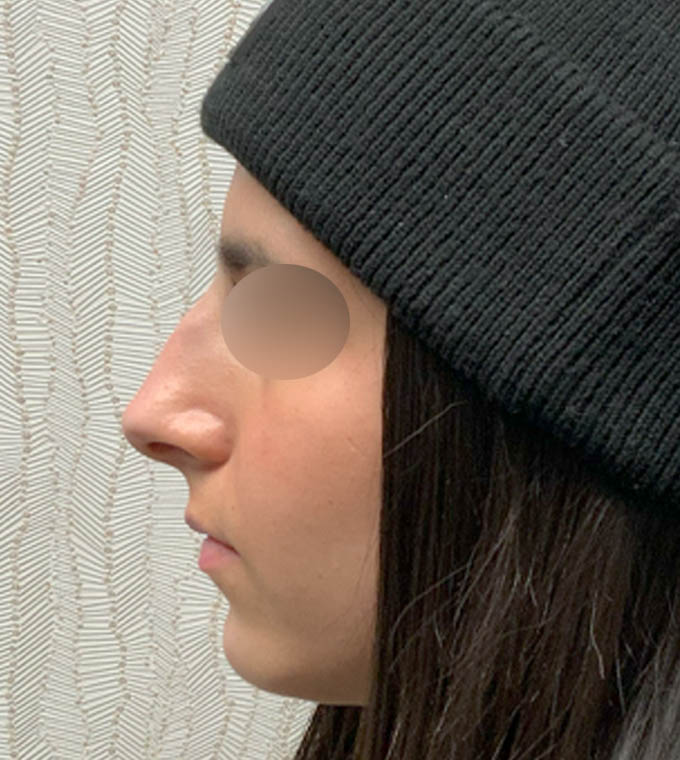 Rhinoplasty