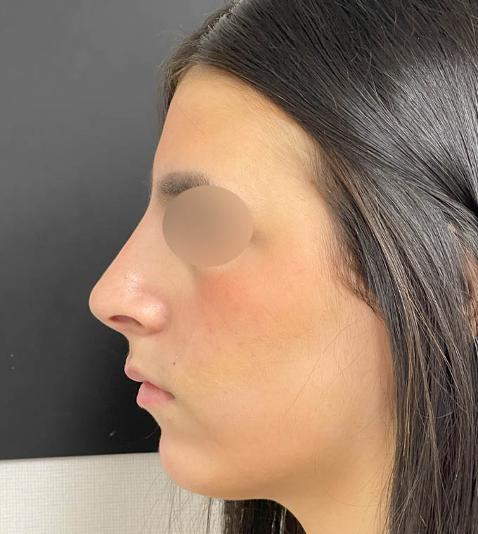 Rhinoplasty