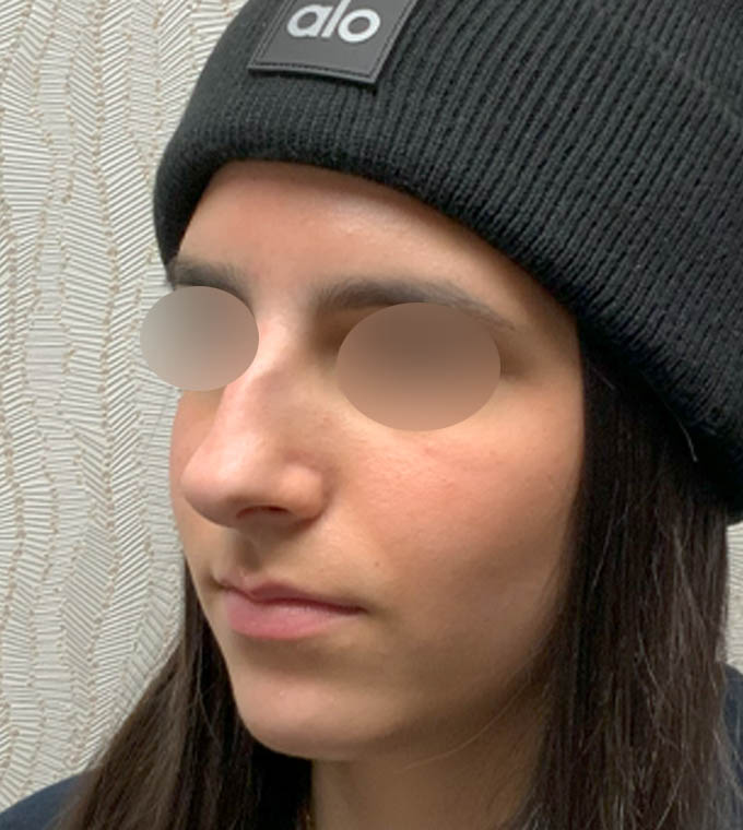Rhinoplasty