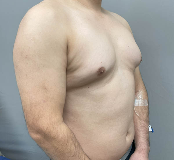 Gynecomastia