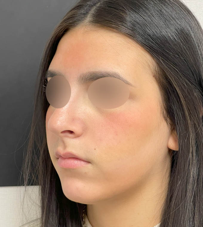 Rhinoplasty
