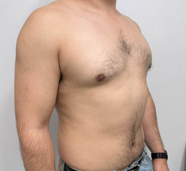 Gynecomastia