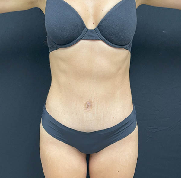 Tummy Tuck