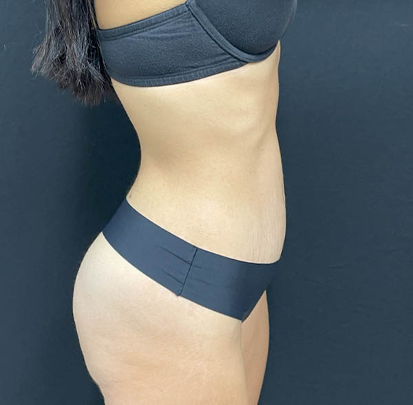 Tummy Tuck