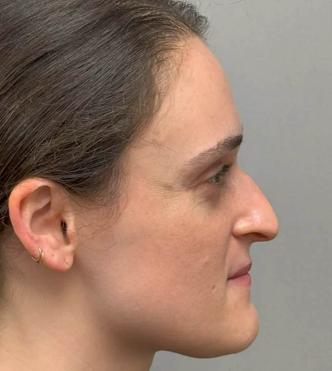Rhinoplasty