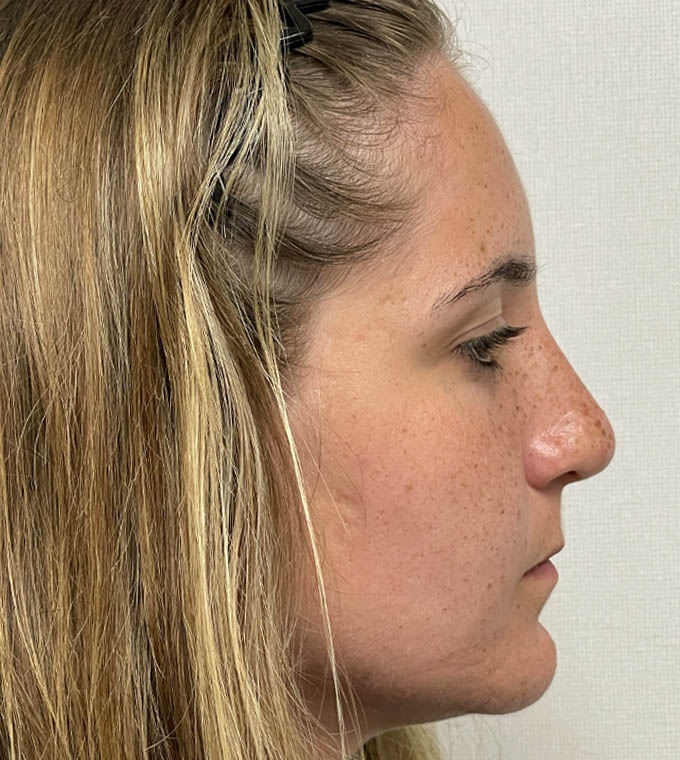 Rhinoplasty