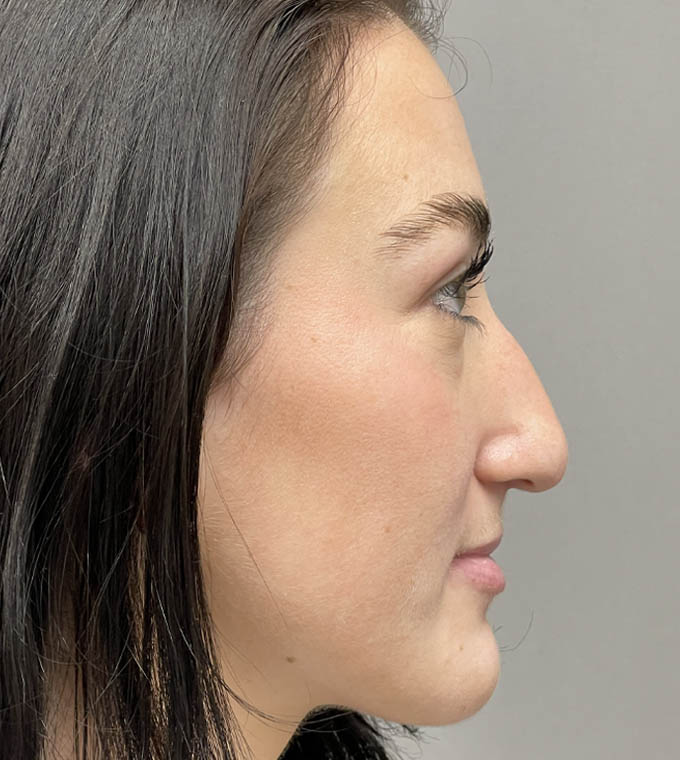 Rhinoplasty