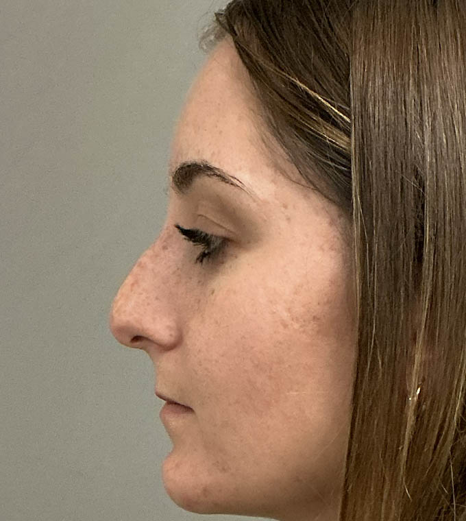 Rhinoplasty