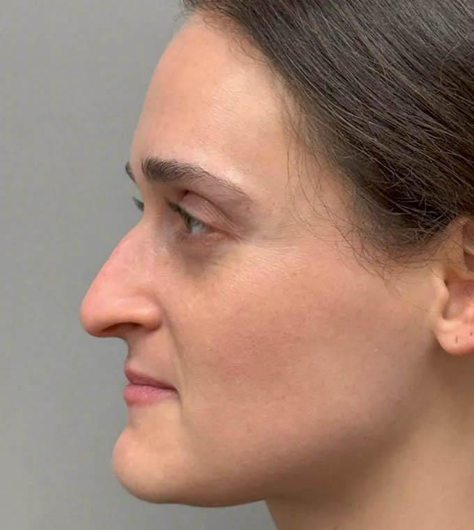 Rhinoplasty