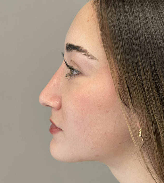 Rhinoplasty