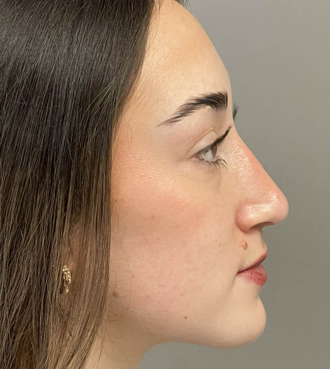 Rhinoplasty