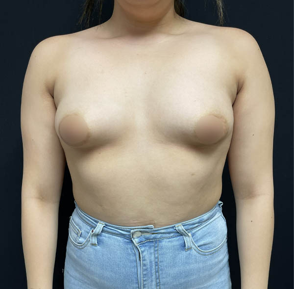 Breast Augmentation
