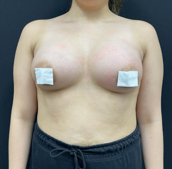 Breast Augmentation