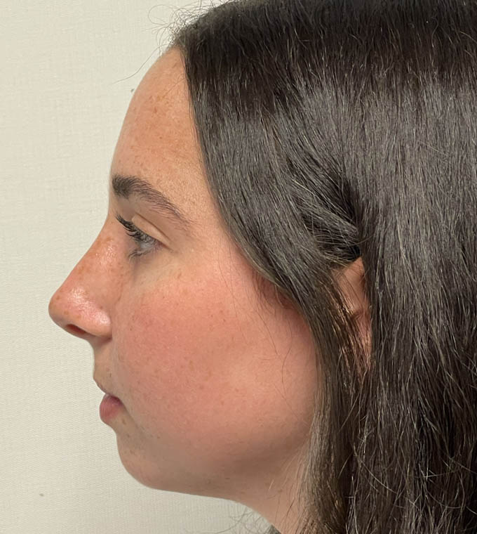 Rhinoplasty