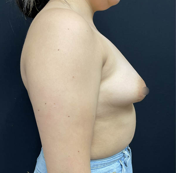 Breast Augmentation