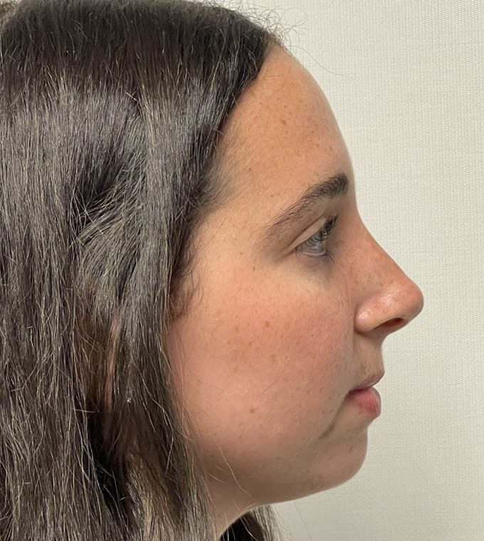 Rhinoplasty