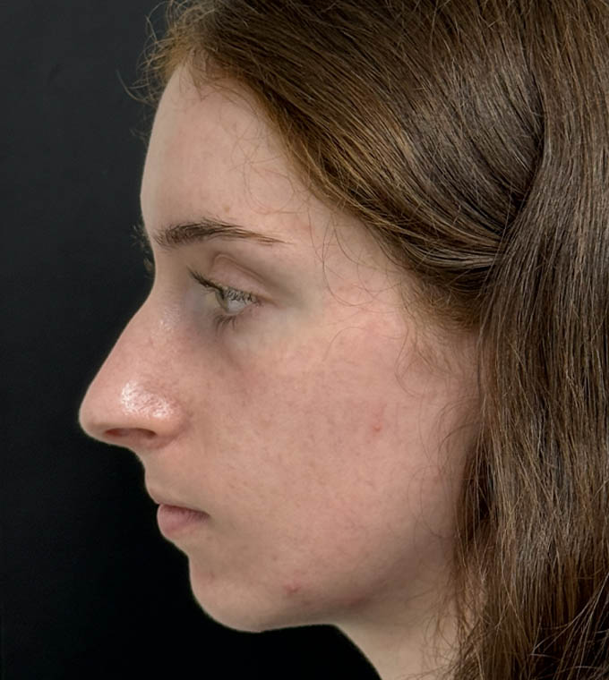 Rhinoplasty