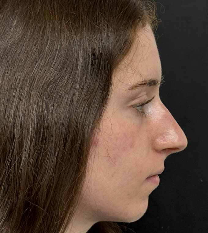 Rhinoplasty