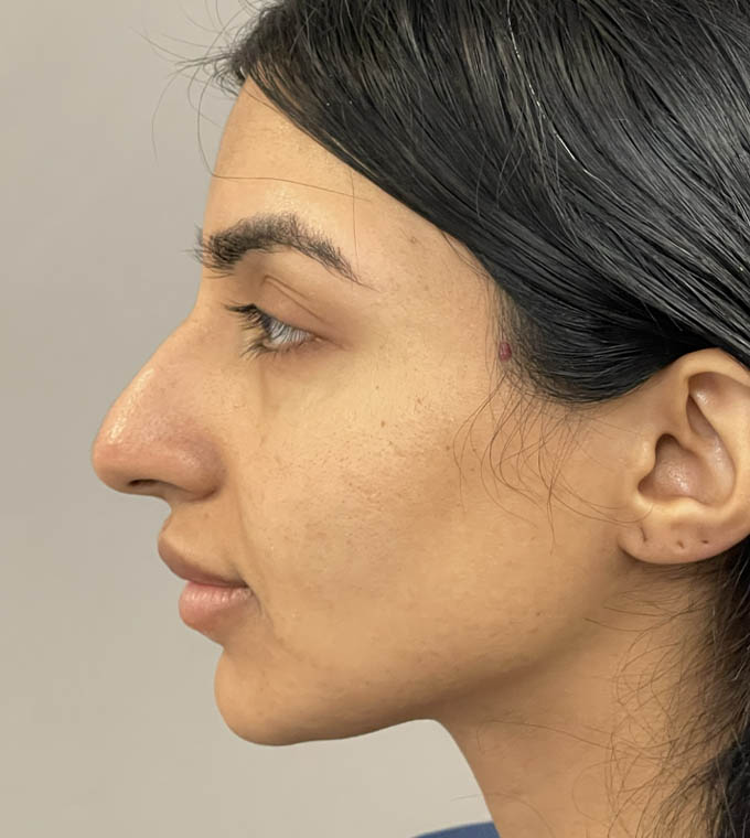 Rhinoplasty