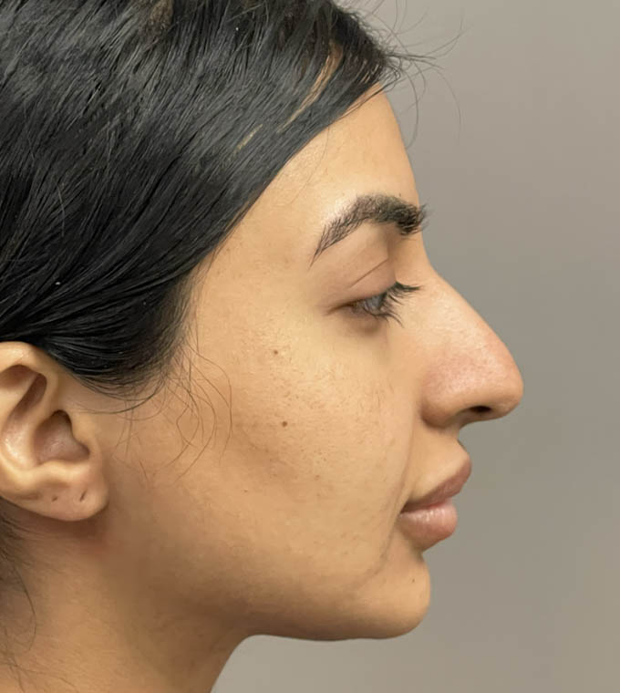 Rhinoplasty