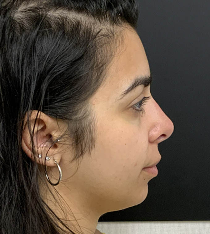 Rhinoplasty