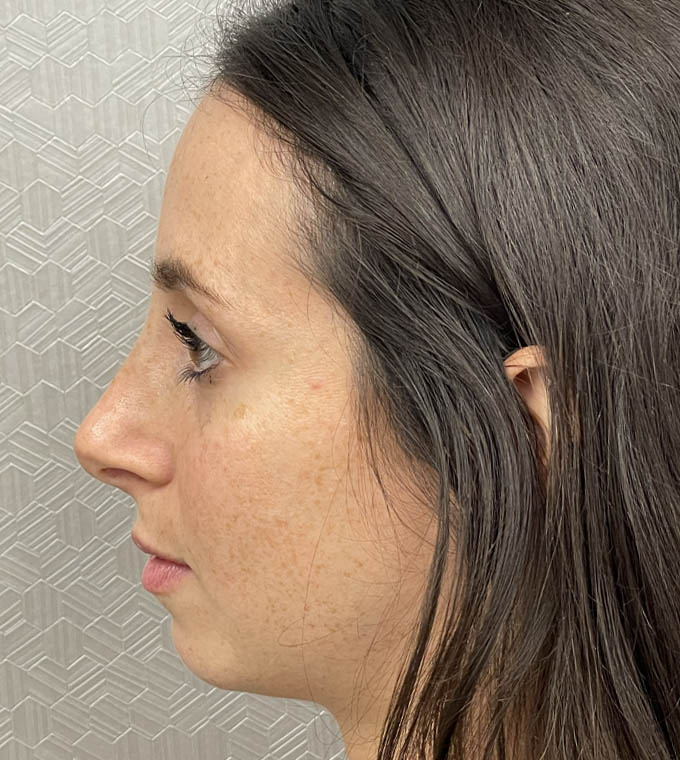 Rhinoplasty