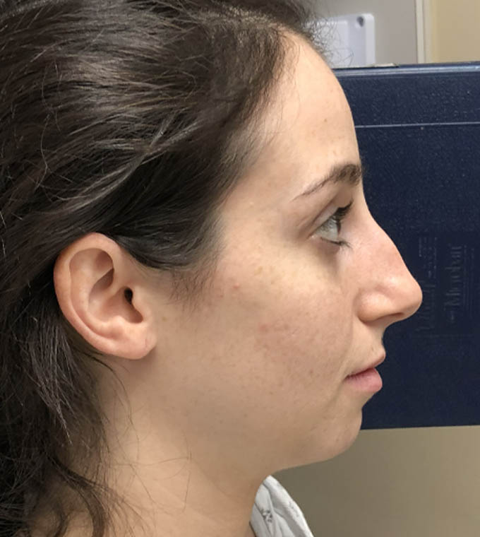 Rhinoplasty