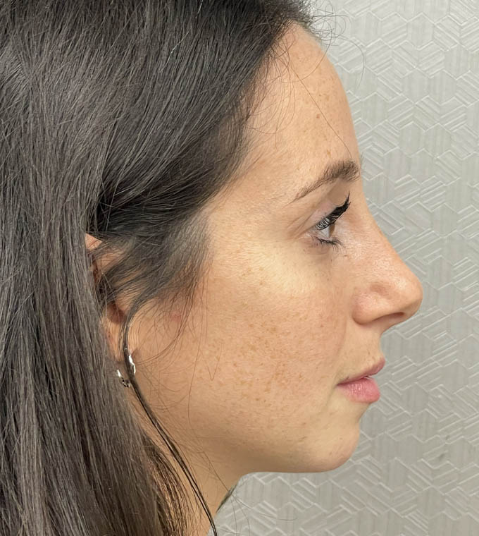 Rhinoplasty