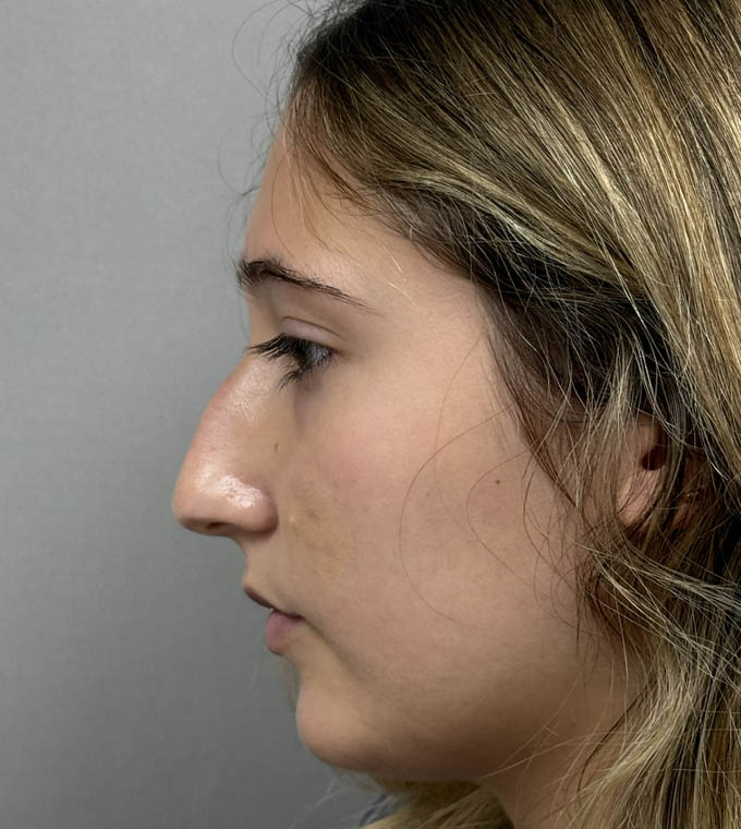 Rhinoplasty