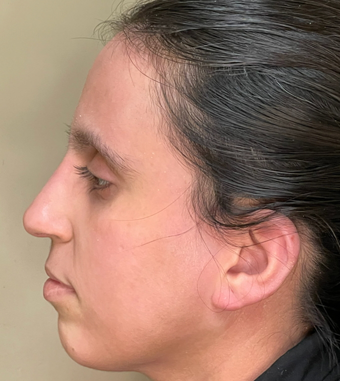 Rhinoplasty