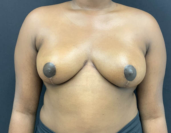 Breast Reduction