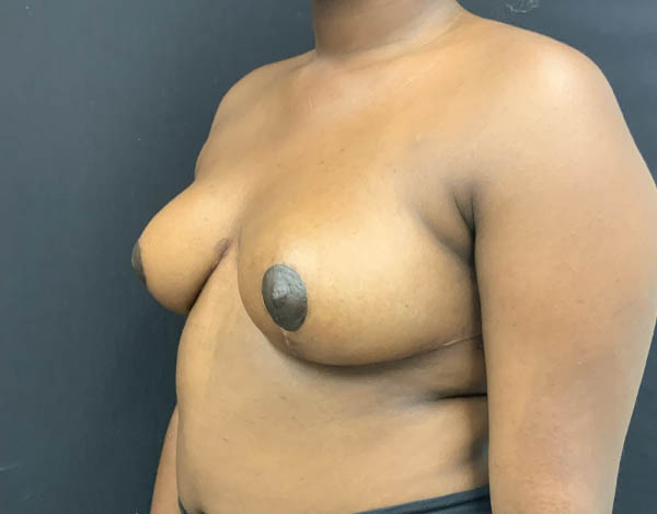 Breast Reduction