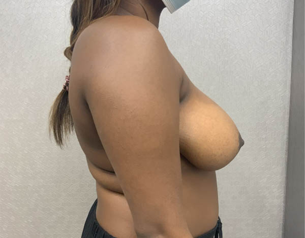 Breast Reduction