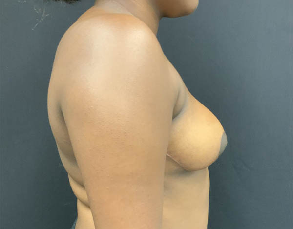 Breast Reduction