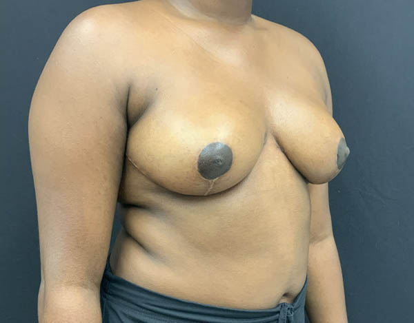 Breast Reduction