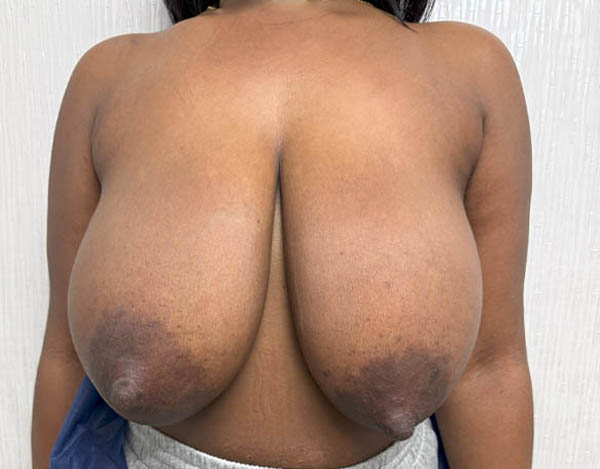 Breast Reduction