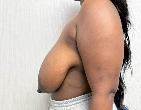 Breast Reduction
