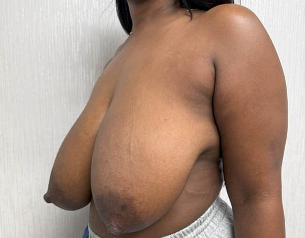 Breast Reduction
