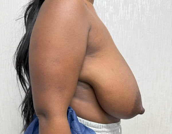 Breast Reduction