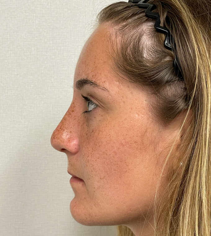 Rhinoplasty